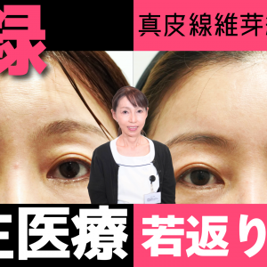 【美容医療の最前線】肌の再生医療「真皮繊維芽細胞療法」とは? 効果、費用、体験談を徹底解説